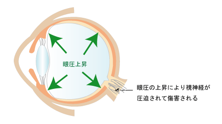 緑内障